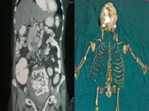 ANNE KARNINDAN 36 YILLIK BEBEK İSKELETİ ÇIKTI