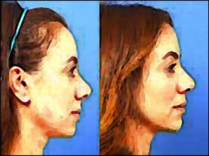 BURUN AMELİYATI OLMADAN ÖNCE