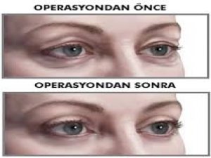 GÖZ KAPAĞI ESTETİĞİ HAKKINDA BİLMEDİKLERİMİZ