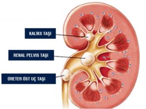 Böbrek Taşı Olan Bu Haberi Mutlaka Okusun