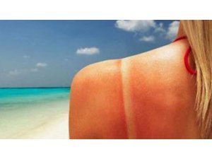 CİLT YANIKLARINDA DOĞRU BİLİNEN YANLIŞLAR