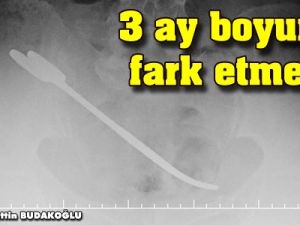 Karnında makasla 3 ay yaşadı