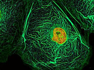 ÜNİVERSİTEDE KANSER PANİĞİ