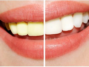 DİŞLERİMİZ NEDEN SARARIR?