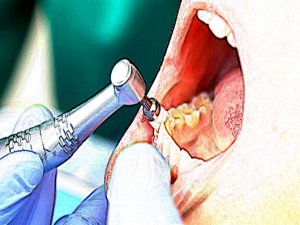 BUNU YAPMAZSANIZ; DİŞ ÇEKTİRİRKEN ÖLEBİLİRSİNİZ