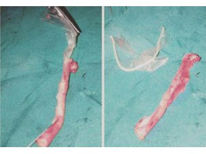 APANDİSİNDEN PREZERVATİF ÇIKTI