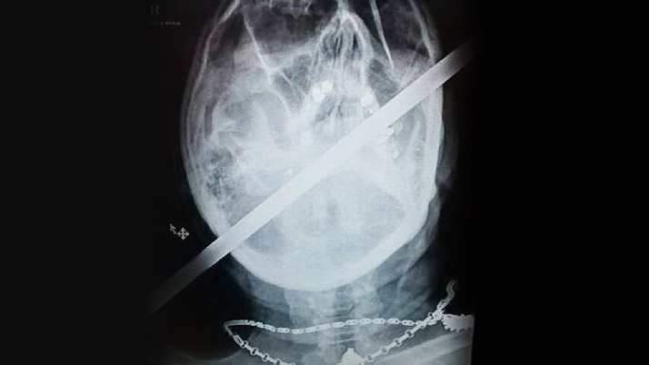 KAFASINA DEMİR ÇUBUK SAPLANAN ADAMIN MUCİZE KURTULUŞU