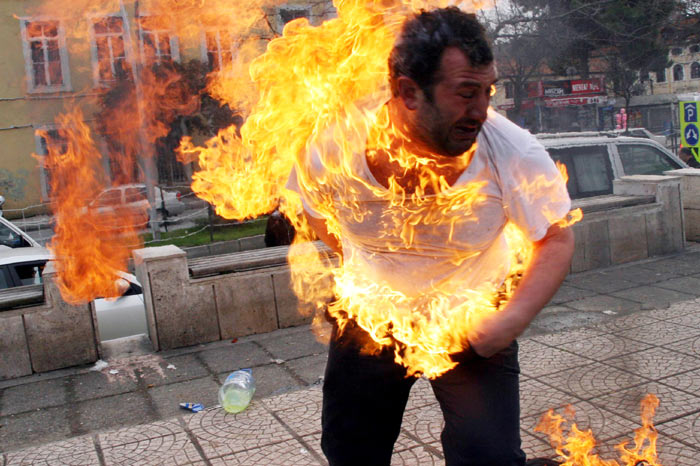 "AÇIM" DİYE BAĞIRDI KENDİNİ BÖYLE YAKTI ; YOĞUN BAKIMDA