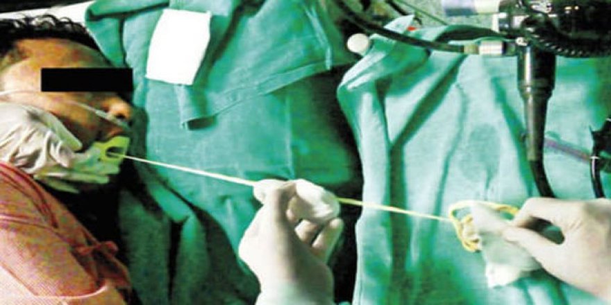 MİDESİNDEN İKİ METRELİK TENYA ÇIKTI