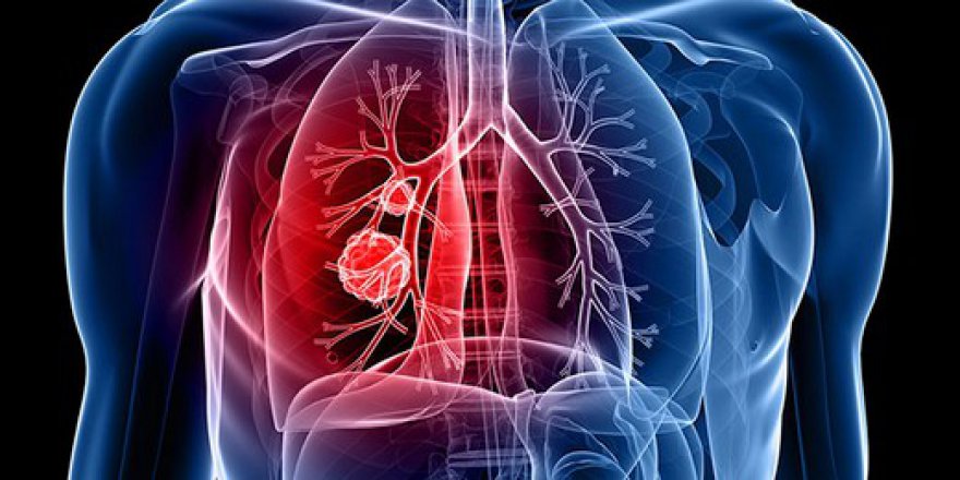 Akciğer kanseri hastalarına teknoloji umudu