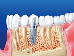 Dişlerini İmplant Yaptıracaklar Dikkat
