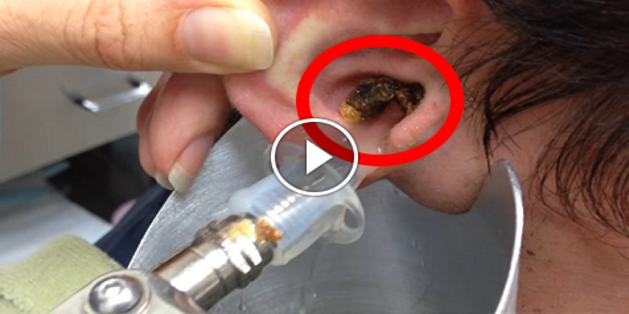 Bunu izledikten sonra bir daha kulak çubuğu kullanmayacaksınız