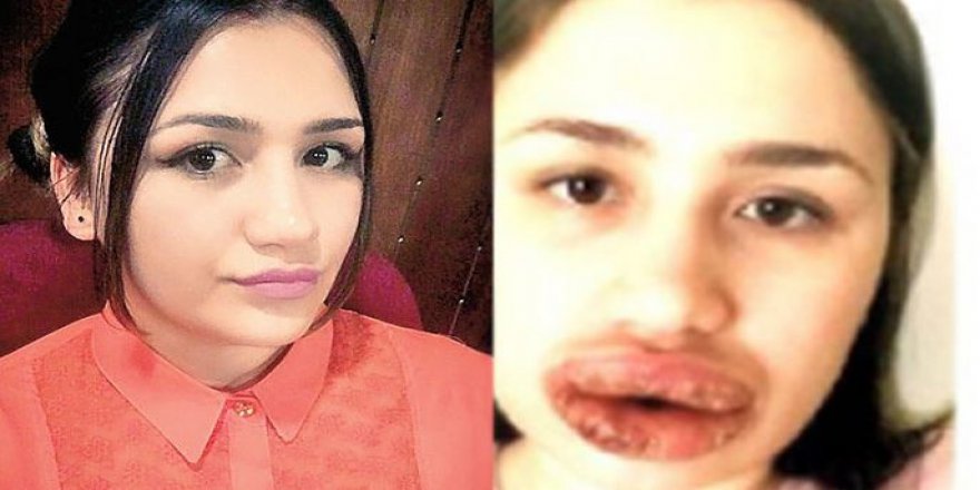 Merve Keleş'e silikon dolgu yapan kuaförden şok savunma