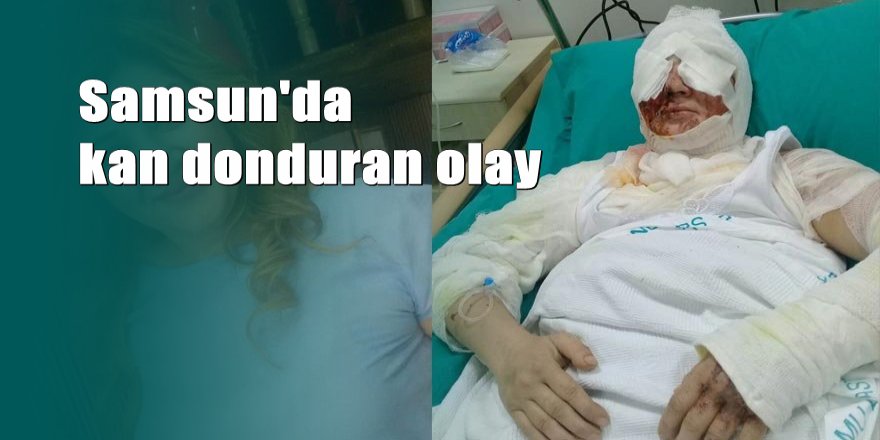 Tecavüz etmek istediği Azeri kadını kezzap ile yaktı