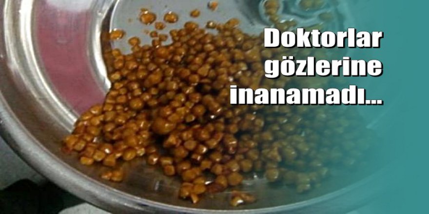 Safra kesesinden 710 adet taş çıkarıldı