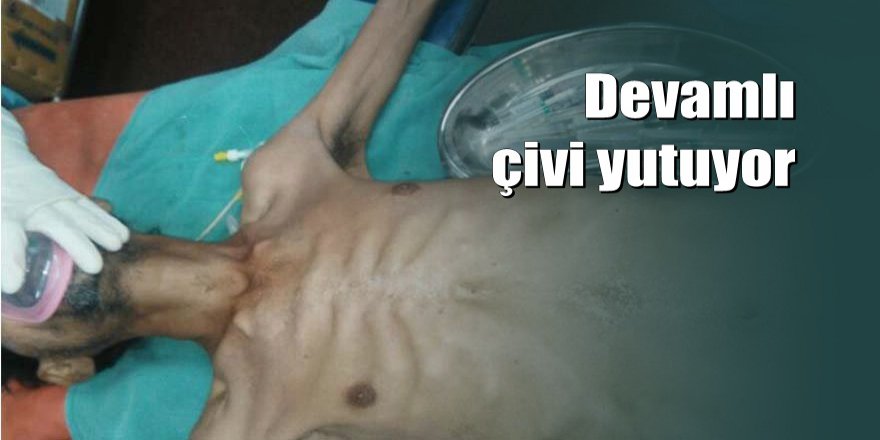 Midesinden 600 çivi çıktı