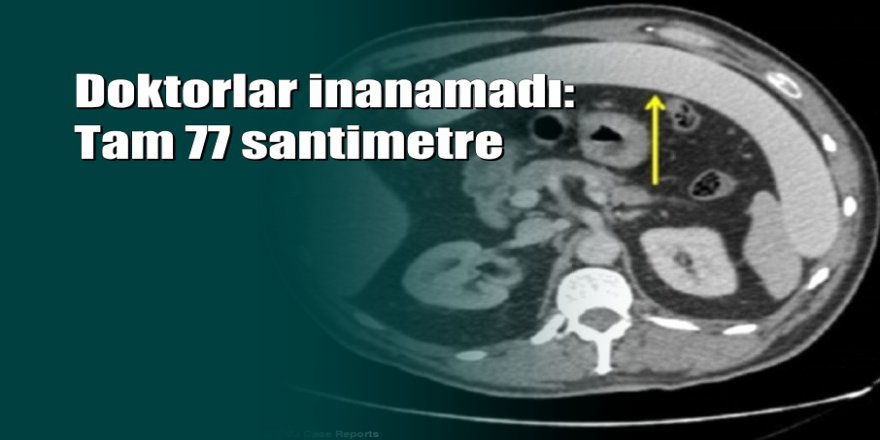 53 yaşındaki adamın anüsünden fantezi oyuncağı çıktı