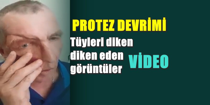 Yüzü parçalanan adama takılan protezin görüntüleri çok tartışılacak