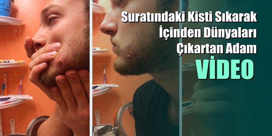 Suratındaki Kisti Sıkarak İçinden Dünyaları Çıkartan Adam