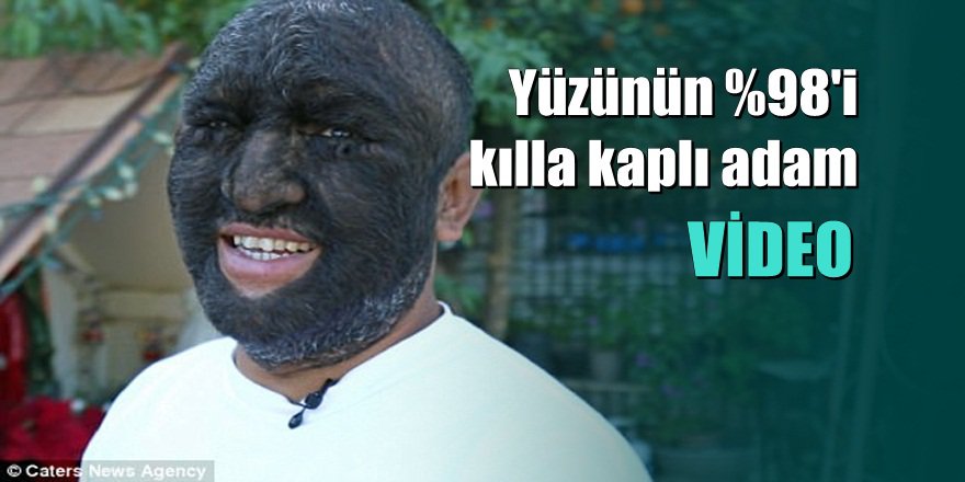 Dünyanın En Kıllı İnsanı: Yüzünün %98'i Kılla Kaplı Adam