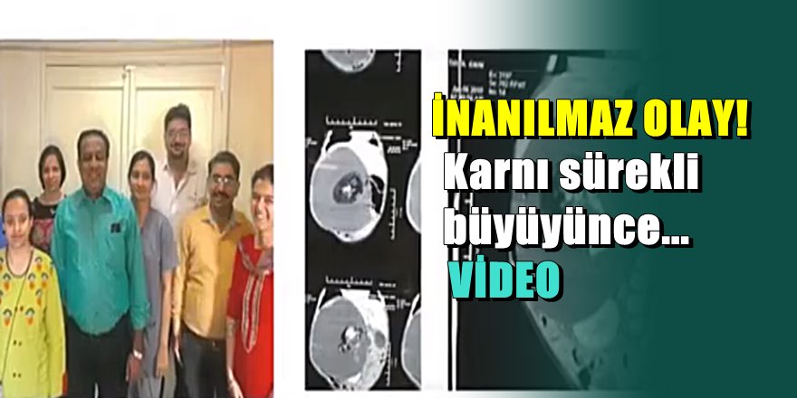 Böbreklerinin arasında ikiz kardeşi varmış