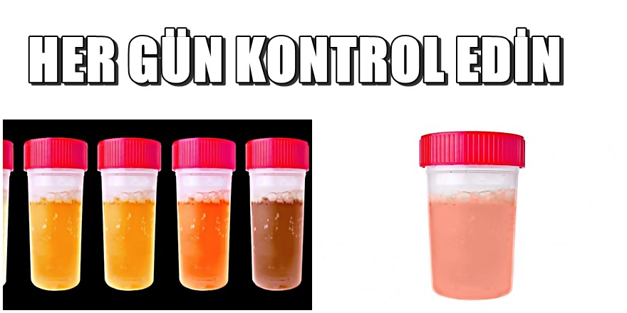 İdrarınız bu renkse derhal doktora gidin