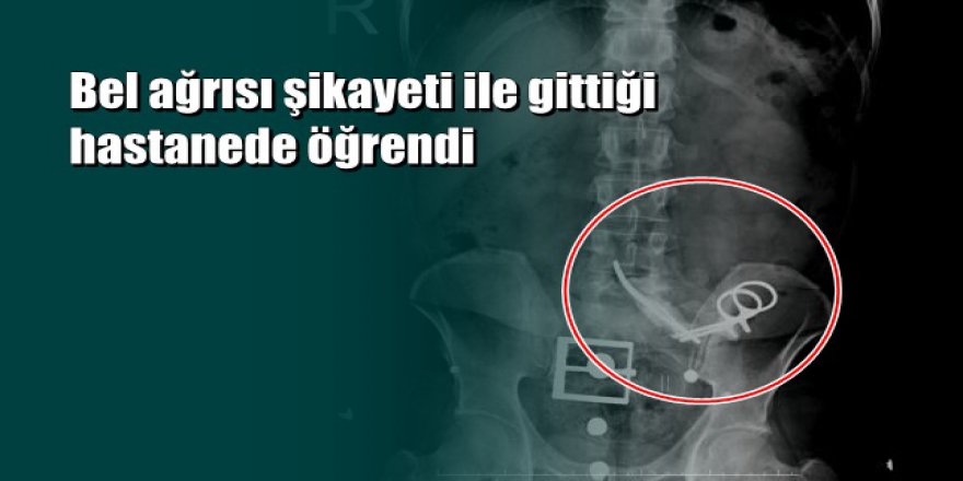 23 yıl ameliyatta karnında unutulan makasla yaşadı