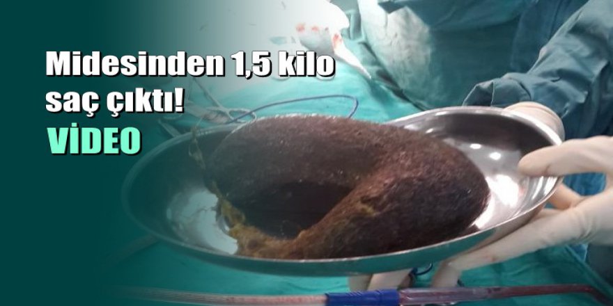 Antalya'da ağrı şikayetiyle hastaneye gitti midesinden 1,5 kilo saç çıktı