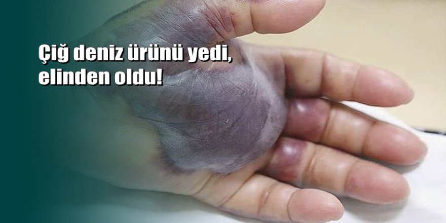 Çiğ deniz ürünü yedi, elinden oldu