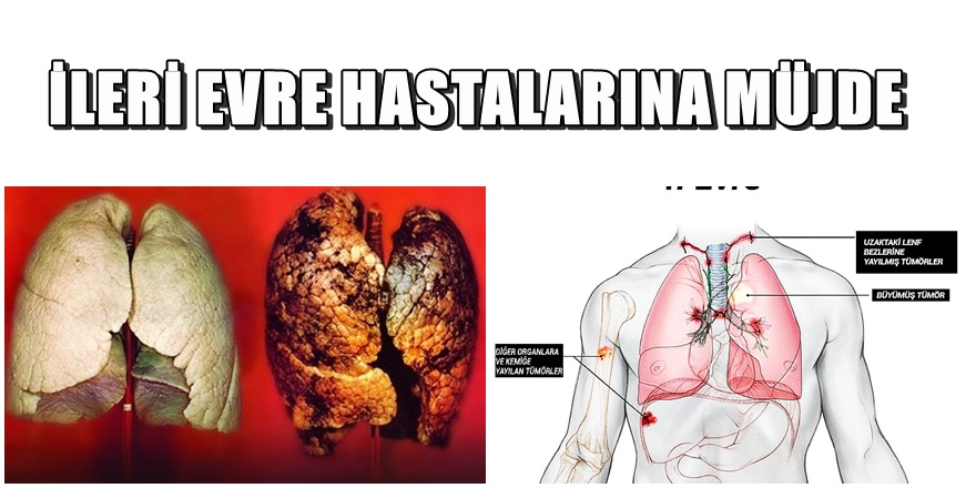 Akciğer Kanseri 4. Evre tedavisinde müjdeli haber