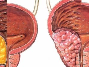 Prostat Kanserinden Korkmayın